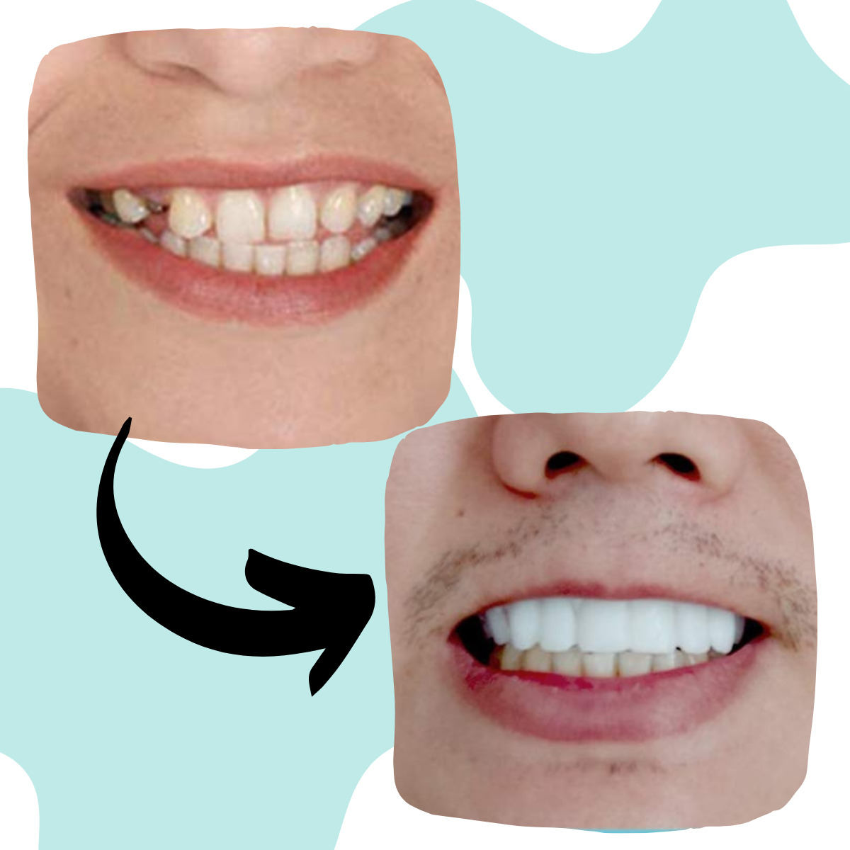 Dientes Postizos Temporal Sonrisa Dental Carilla Estetica